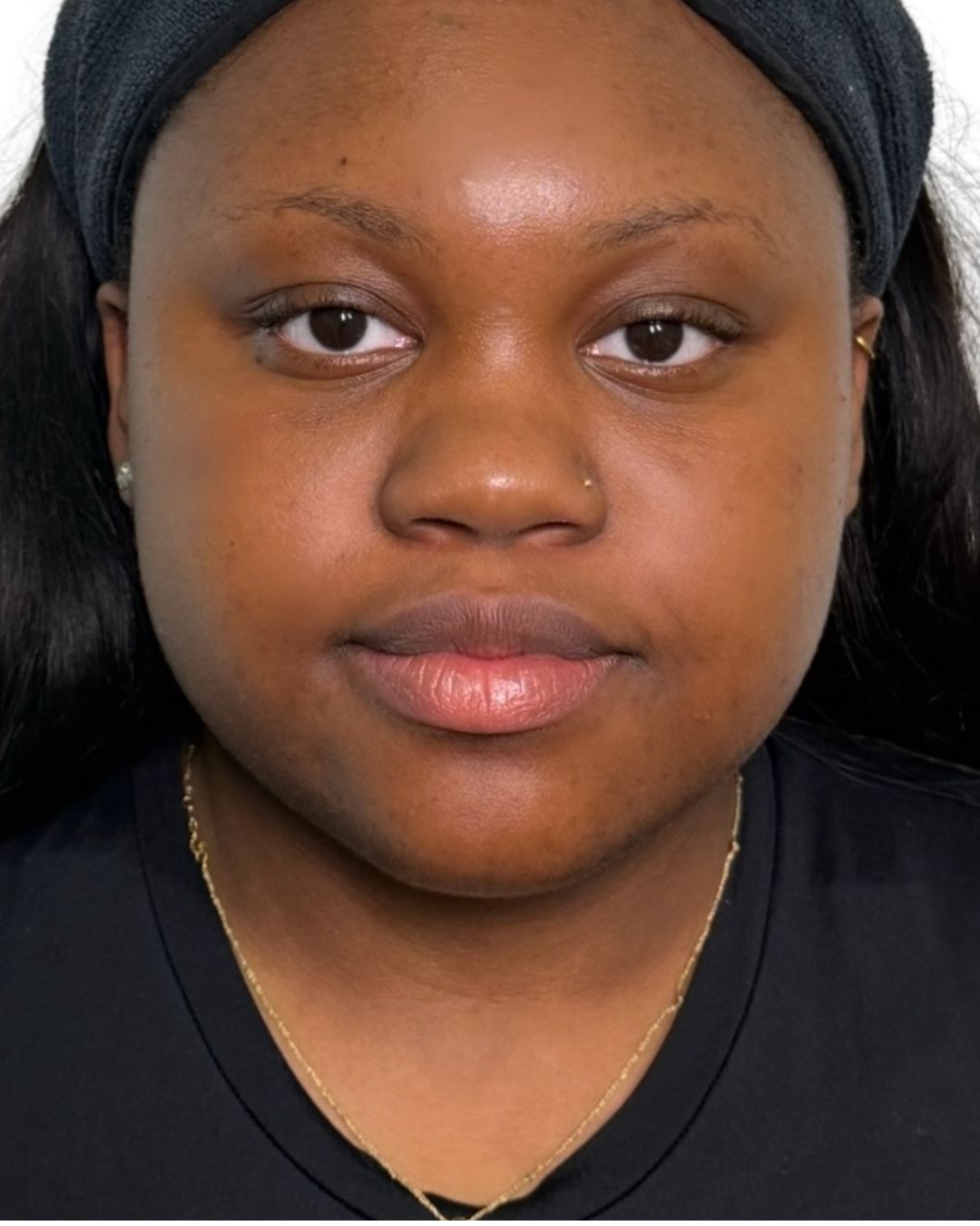After — Microneedling skin renewal at The Refined Co