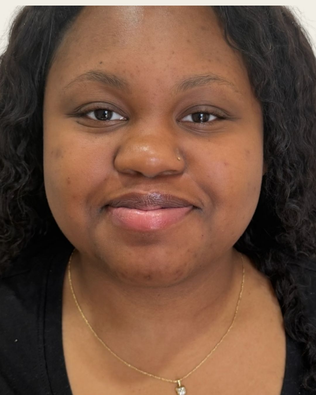Before — Microneedling skin renewal at The Refined Co