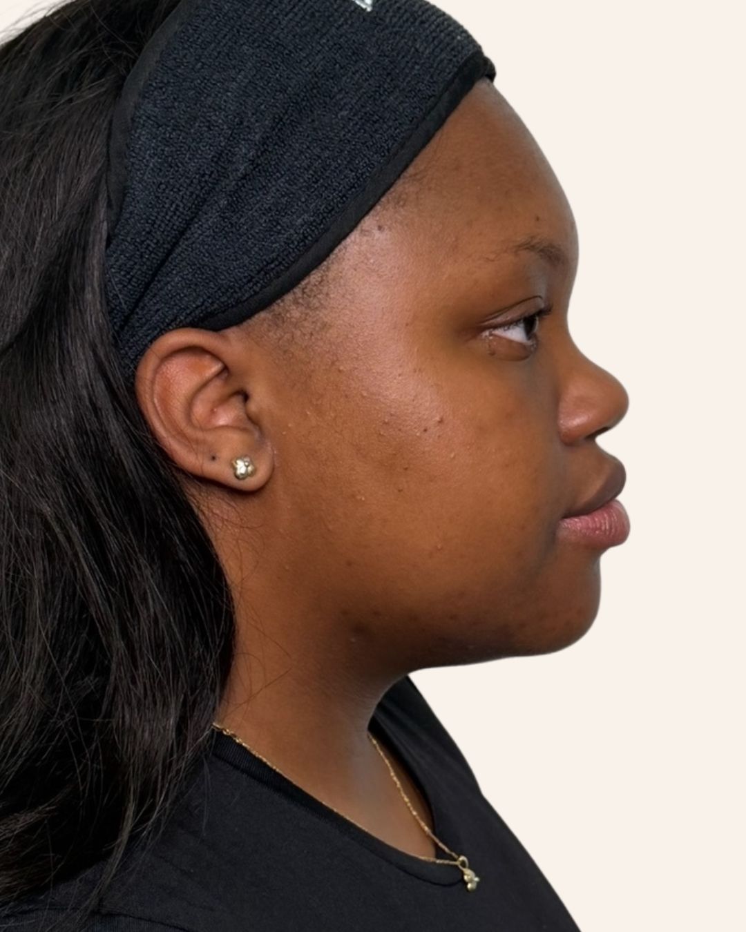 After — Microneedling profile view at The Refined Co