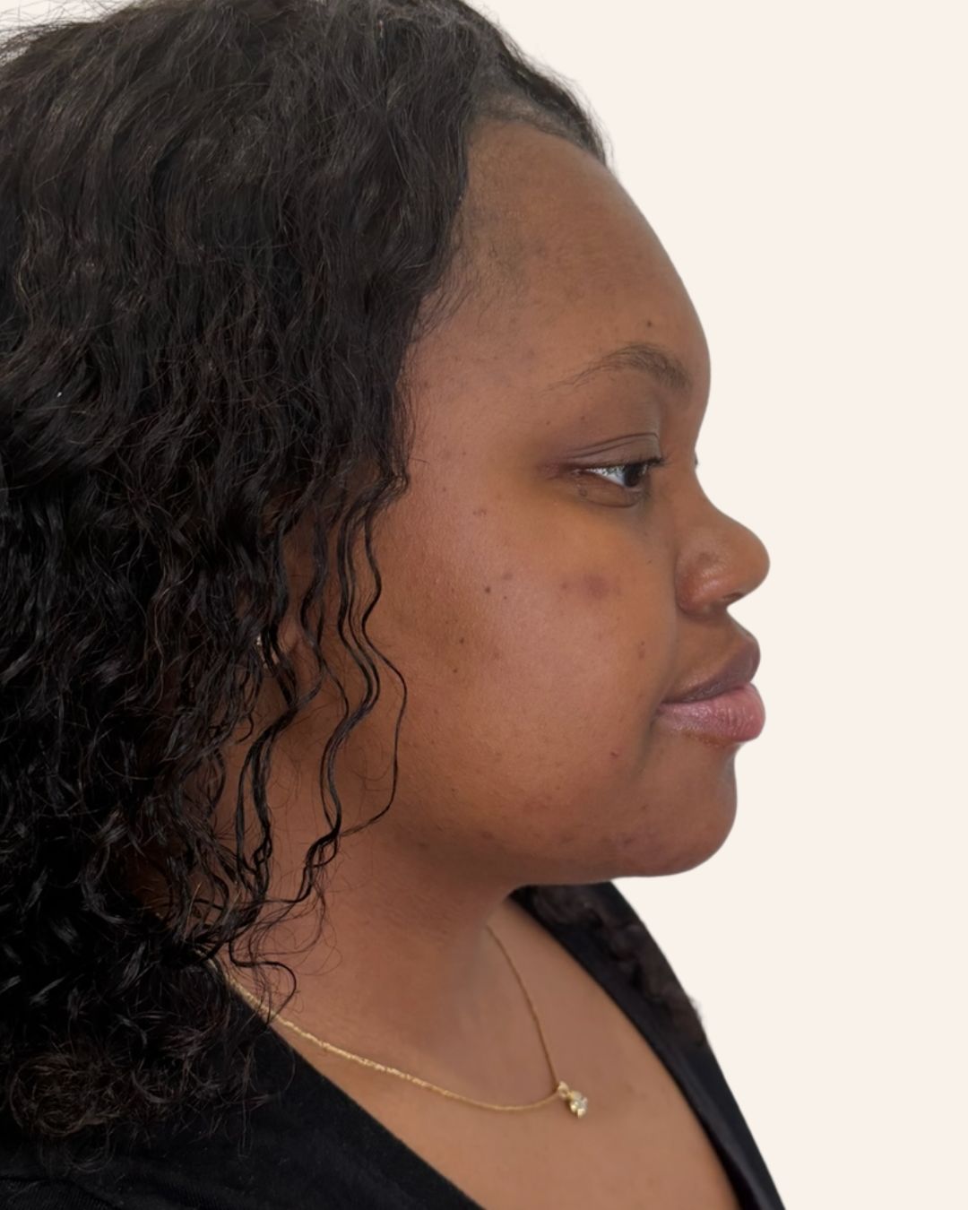 Before — Microneedling profile view at The Refined Co