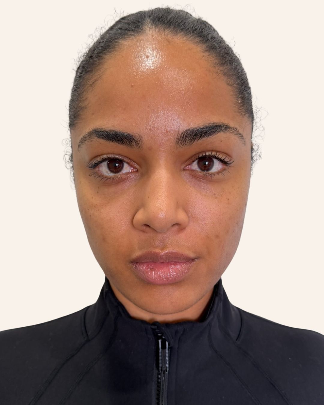 Before — Rejuran Skin Healer Therapy at The Refined Co