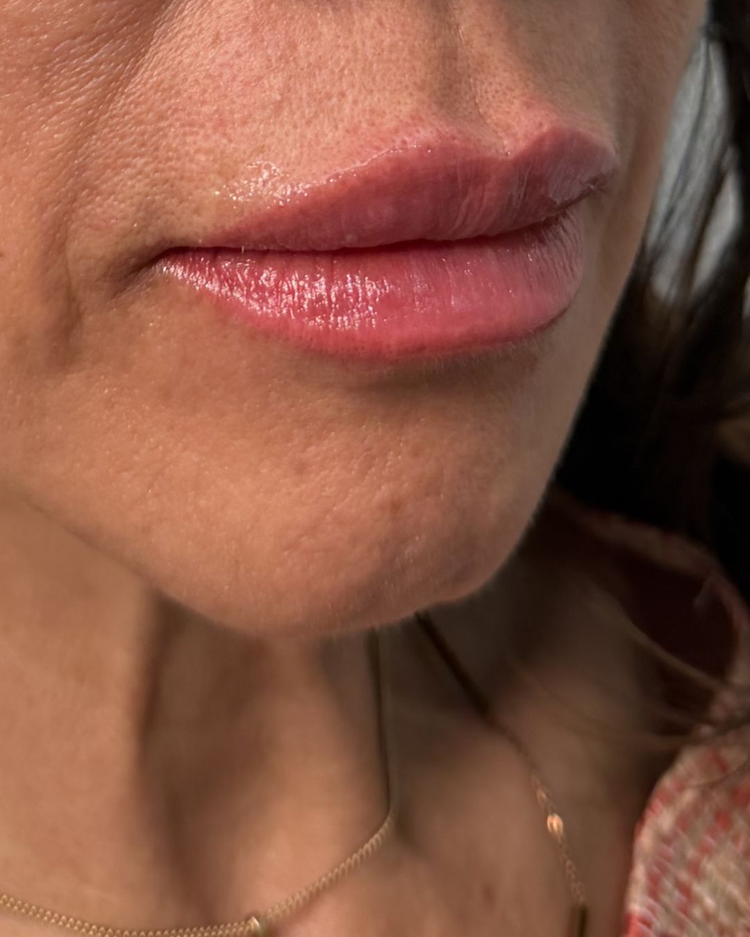 After — Revanesse Versa lip enhancement at The Refined Co