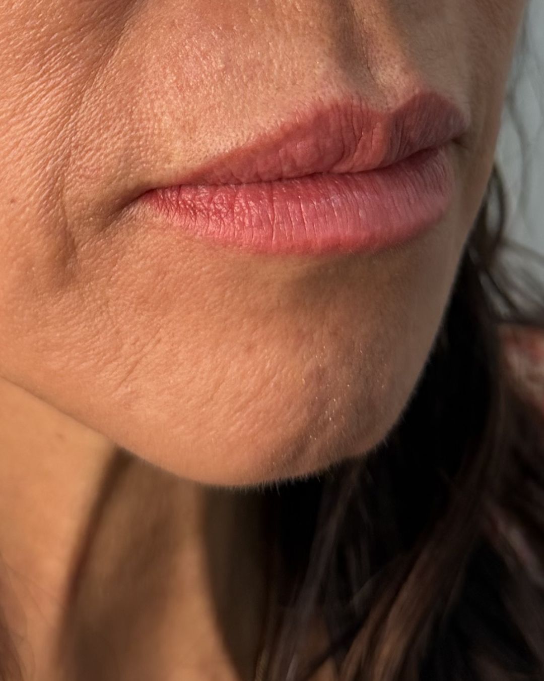 Before — Revanesse Versa lip enhancement at The Refined Co