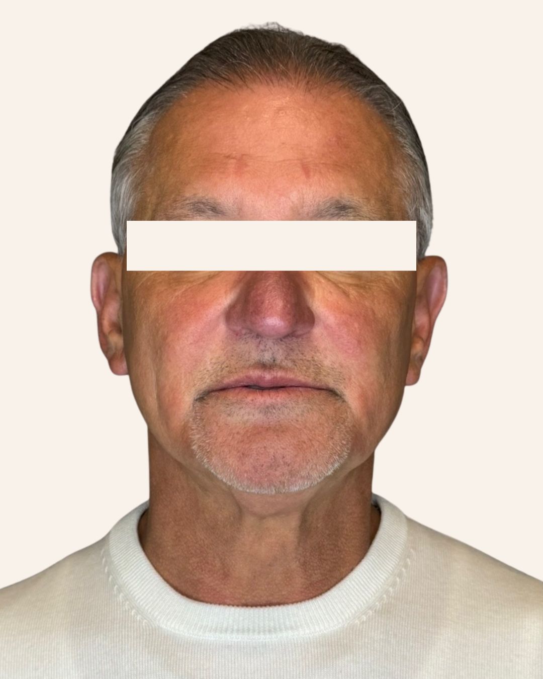 Before — Sculptra collagen restoration at The Refined Co