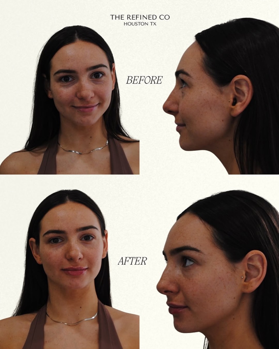 Lip filler enhancement with profile balance at The Refined Co