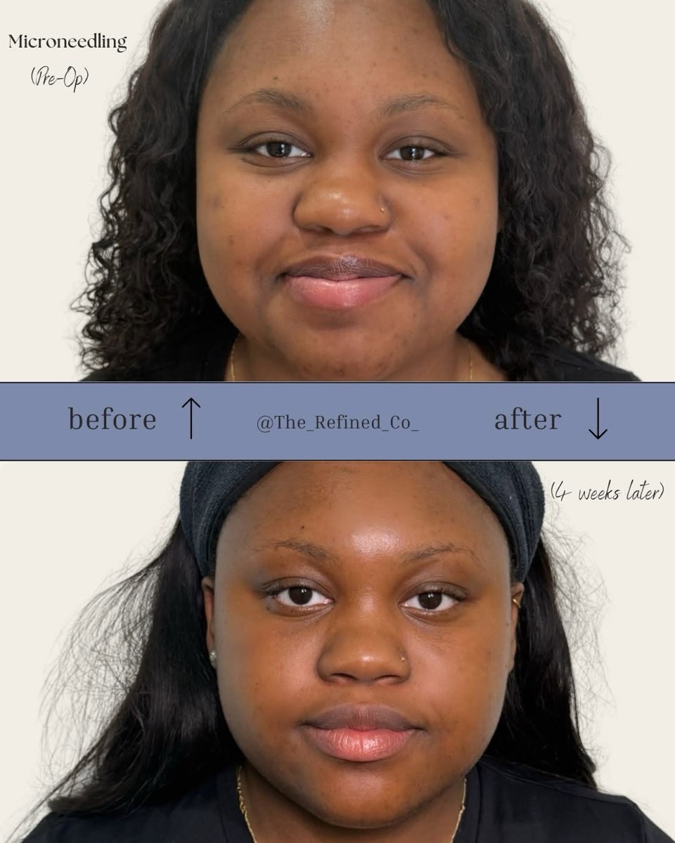Microneedling result at The Refined Co