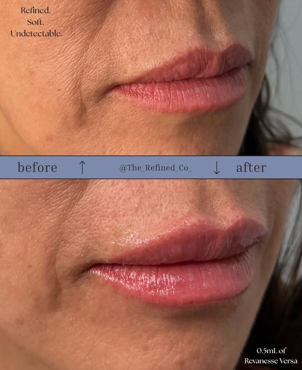Subtle lip enhancement at The Refined Co
