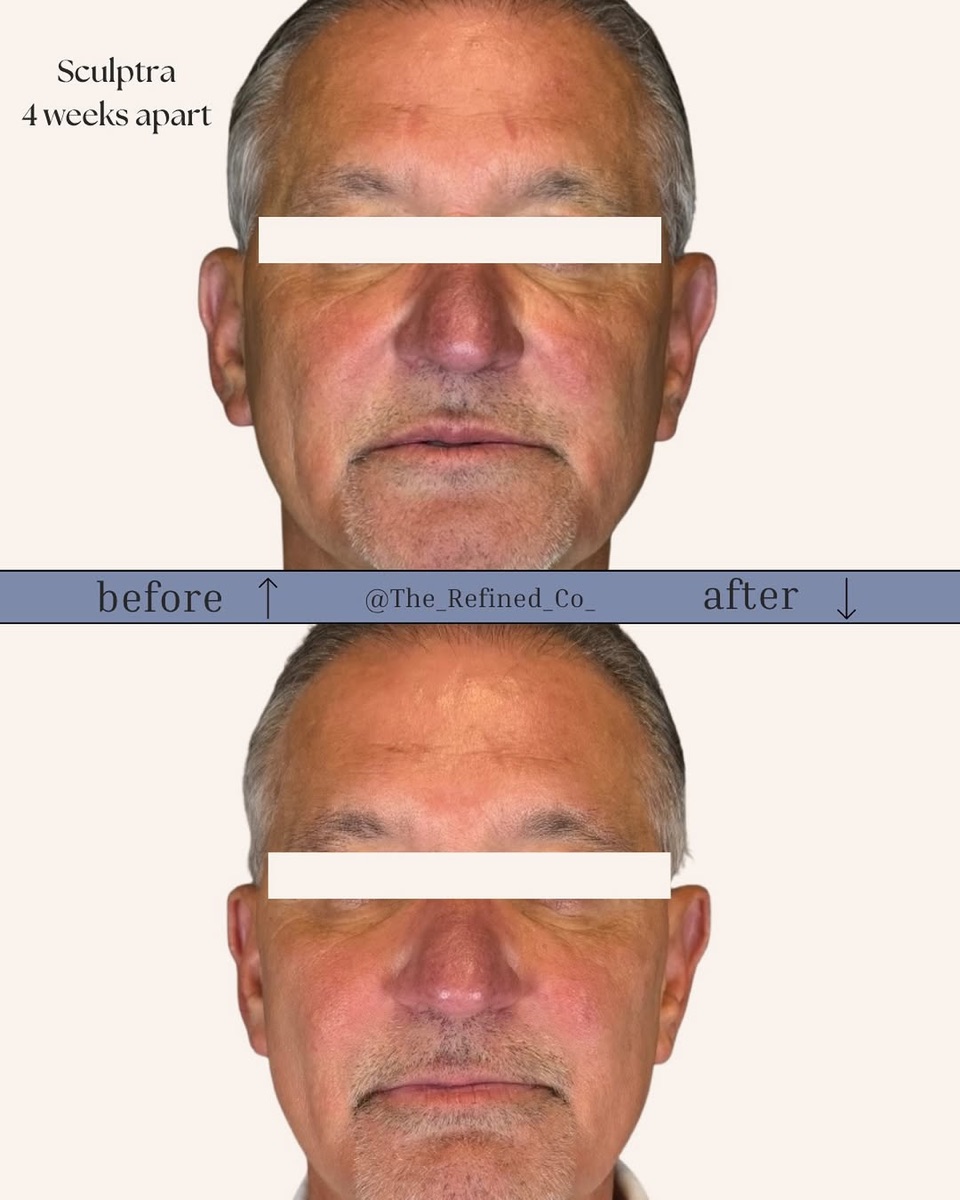 Sculptra collagen result at The Refined Co