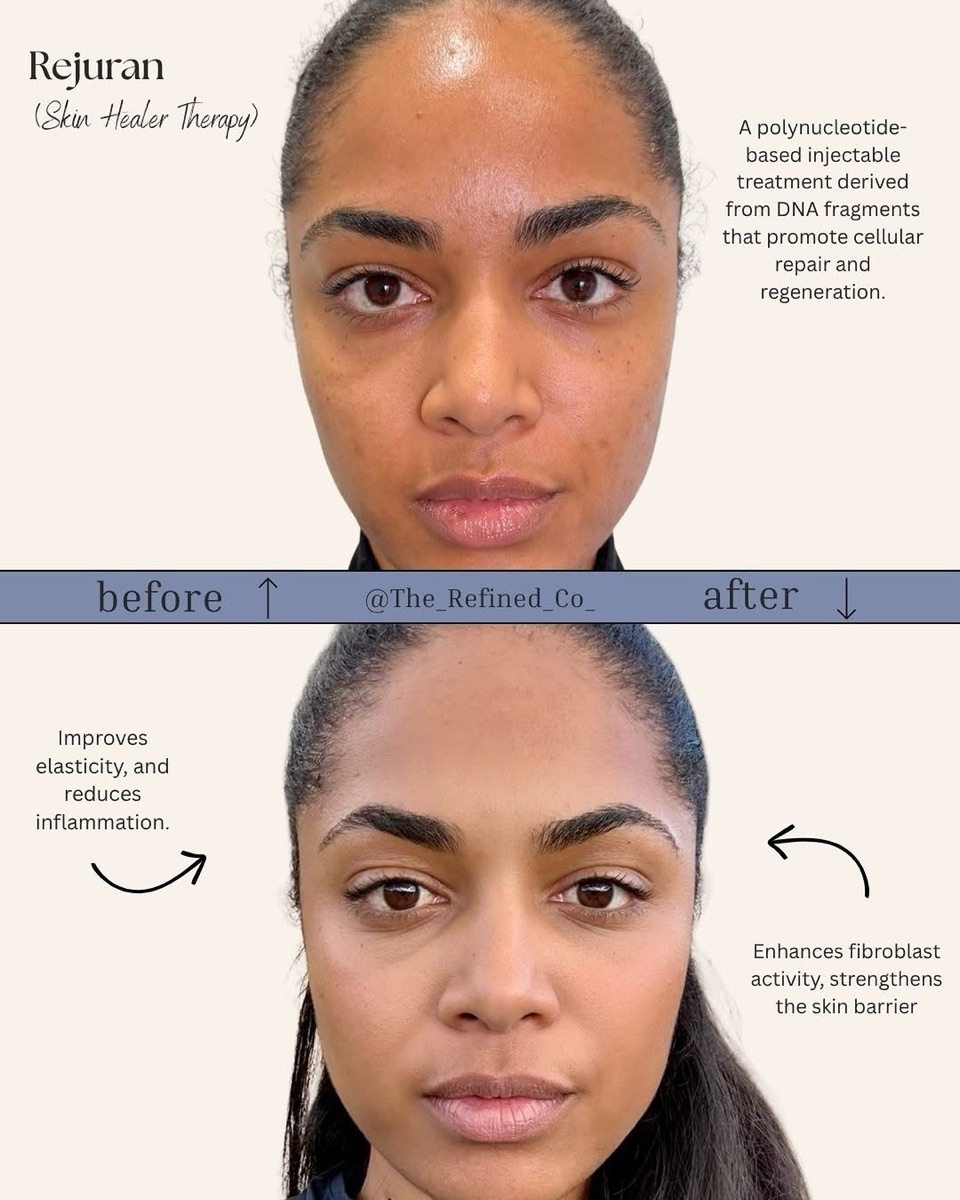 Rejuran skin healer therapy at The Refined Co