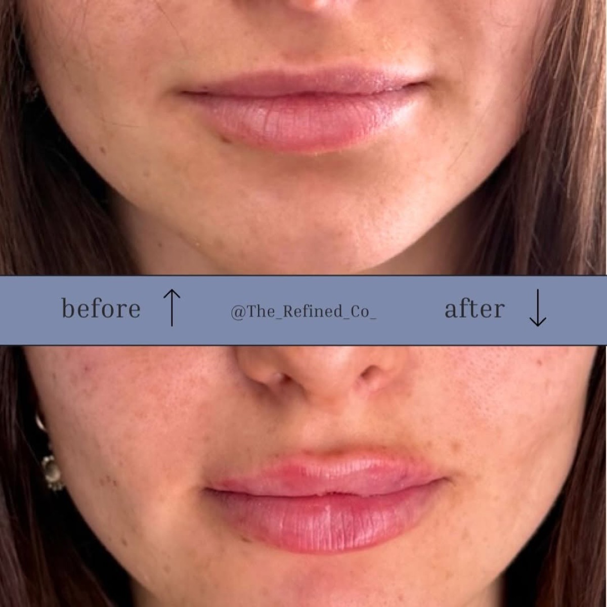 Lip enhancement at The Refined Co