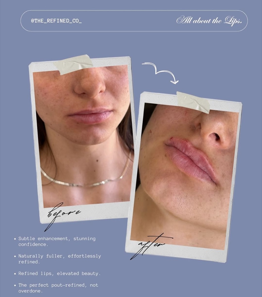 Refined lip enhancement at The Refined Co