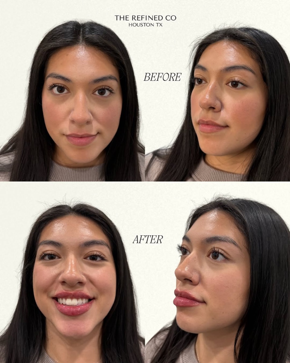 Lip enhancement at The Refined Co