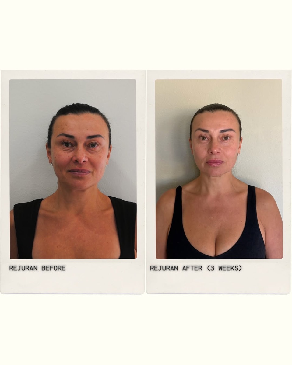 Rejuran result at The Refined Co