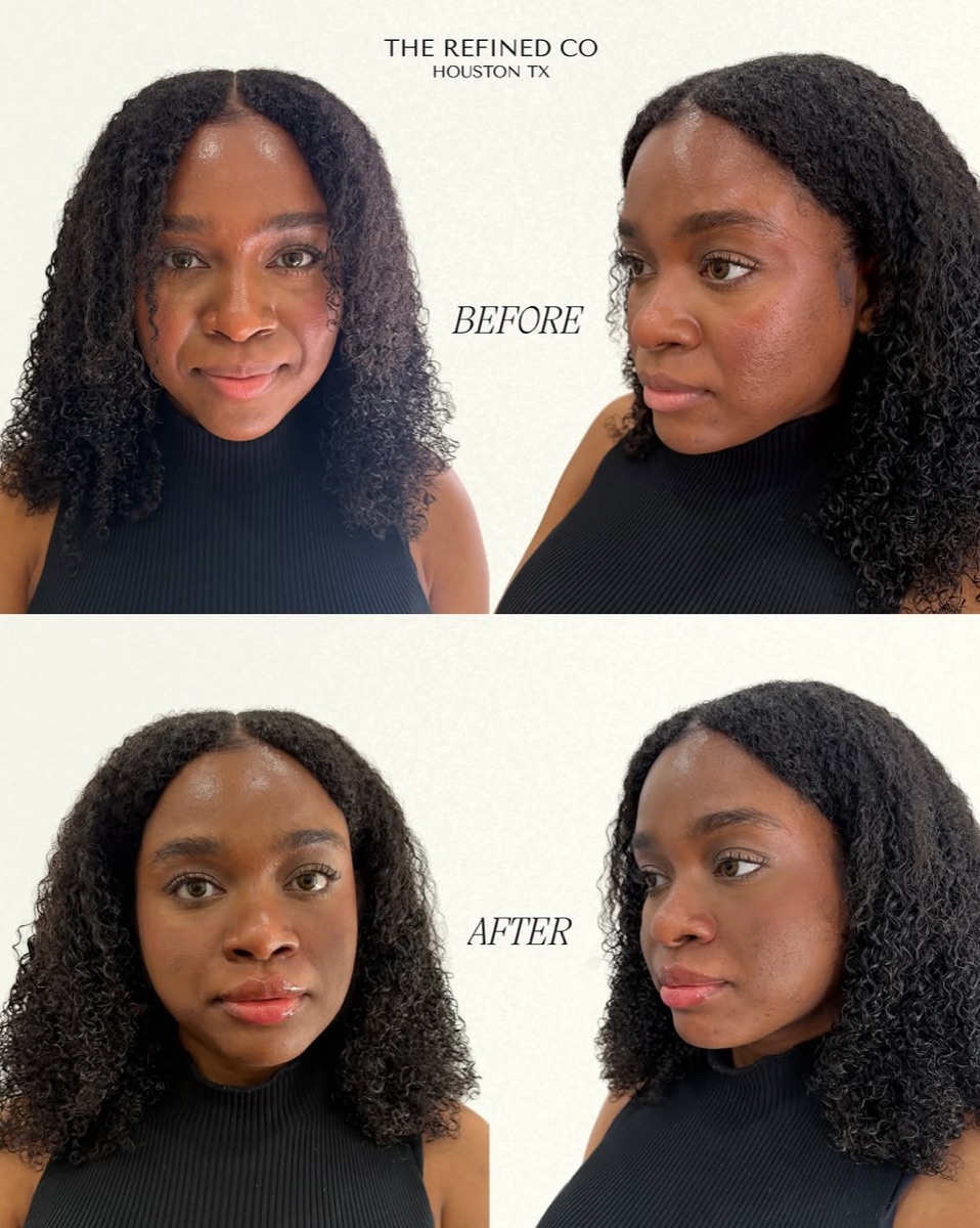 Combined skin quality, lip filler, and nasolabial refinement at The Refined Co