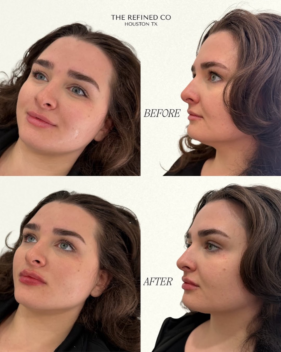Lip filler enhancement with profile balance at The Refined Co