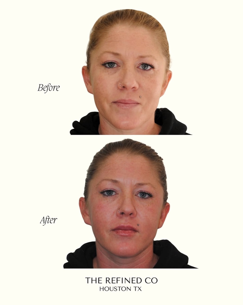 Lip refinement at The Refined Co