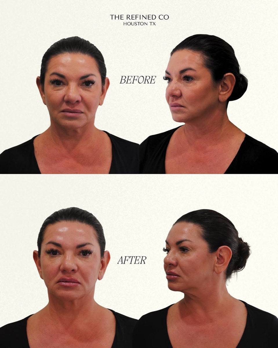 Refined Profile midface filler at The Refined Co